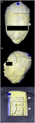 Superior frontal sulcus: a non-eloquent corridor for cavernomas of the internal capsule